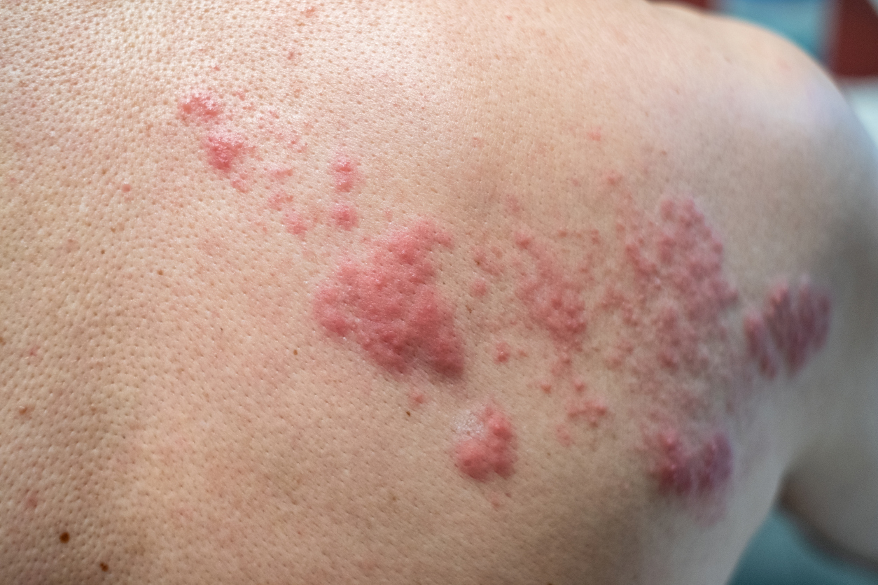 Shingles (Disease), Herpes zoster, varicella-zoster virus. skin rash and blisters on body