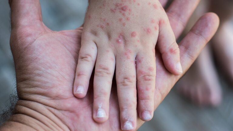 Virus coxsackie en escuelas de Sinaloa