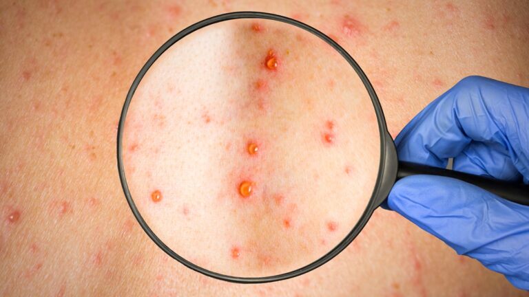 Se registra primera muerte por Sarampión en Sinaloa